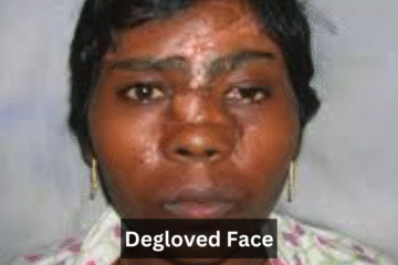 Degloved Face