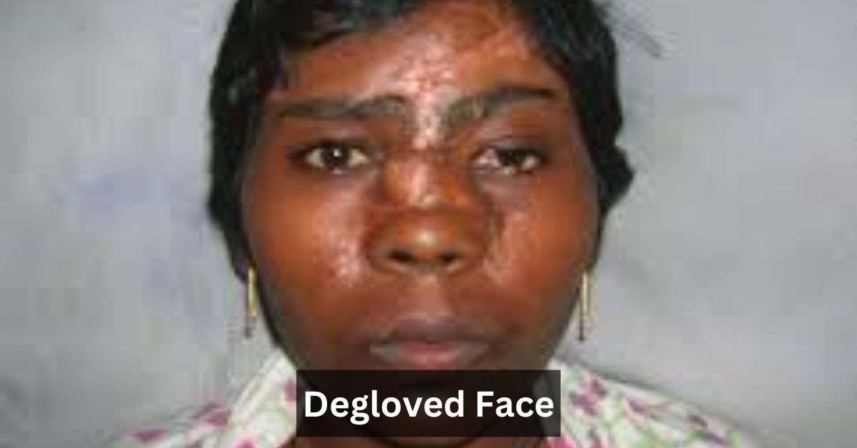 Degloved Face