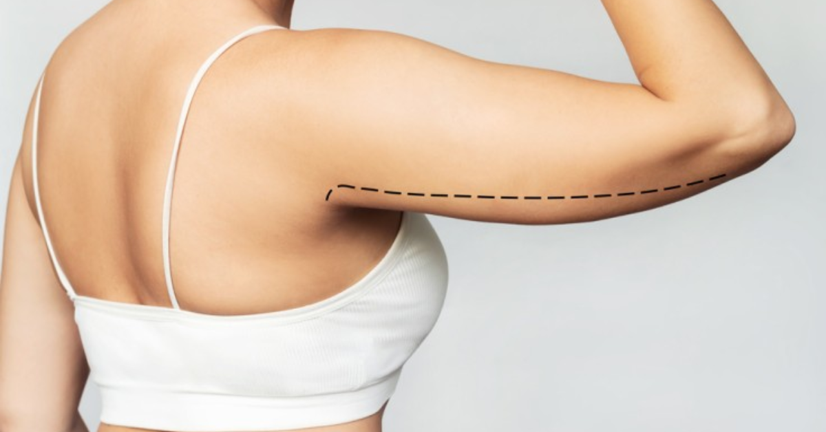Brachioplasty Consultation